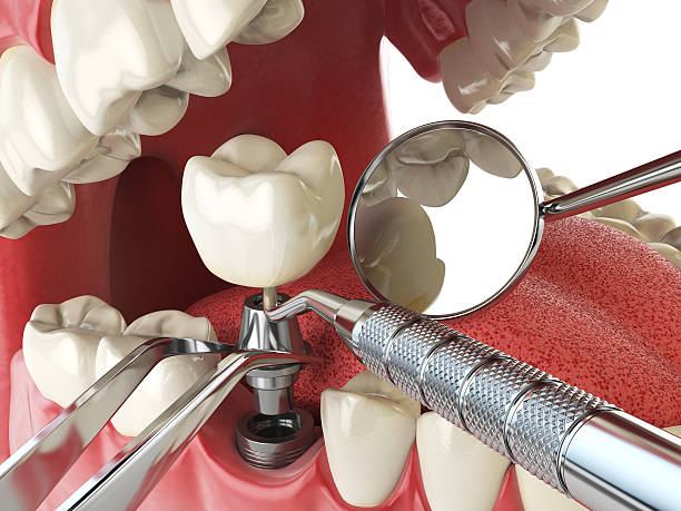Best Emergency Dental Care for Broken or Chipped Teeth in Neillsville, WI